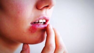 تبخال لب خود را با این روش ها به طور طبیعی و سریع درمان کنید درمان تبخال