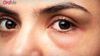 روش موثر برای از بین بردن تیرگی و پف زیر چشم رفع تیرگی و پف زیر چشم