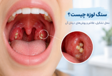 سنگ لوزه چیست؟ محل تشکیل، علائم و روش‌ های درمان