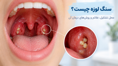 سنگ لوزه چیست؟ محل تشکیل، علائم و روش‌ های درمان