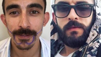 روش های بهتر برای کاشت مو طبیعی با تراکم بالا کاشت مو با تراکم بالا