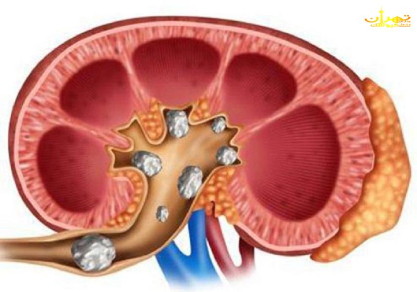 با مصرف چه مواد خوراکی دچار سنگ کلیه می شویم ؟ مواد قندی سنگ کلیه ساز