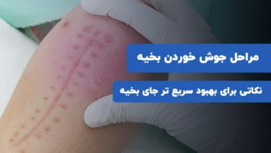 مراحل جوش خوردن بخیه و نکاتی برای بهبود سریع تر جای بخیه مراحل جوش خوردن بخیه و نکاتی برای بهبود سریع تر جای بخیه